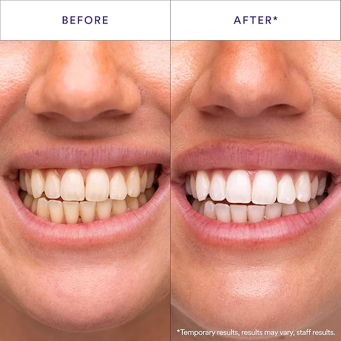 Teeth whitening before-and-after close-up, before left and after right
