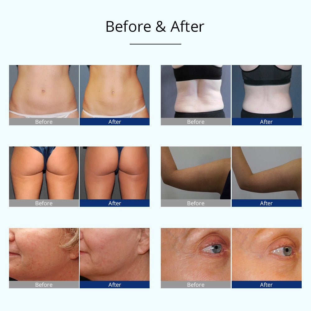 Shape Tactics 4-in-1 Cryolipolysis Cavitation RF Body Contouring System - Renee Lane Company