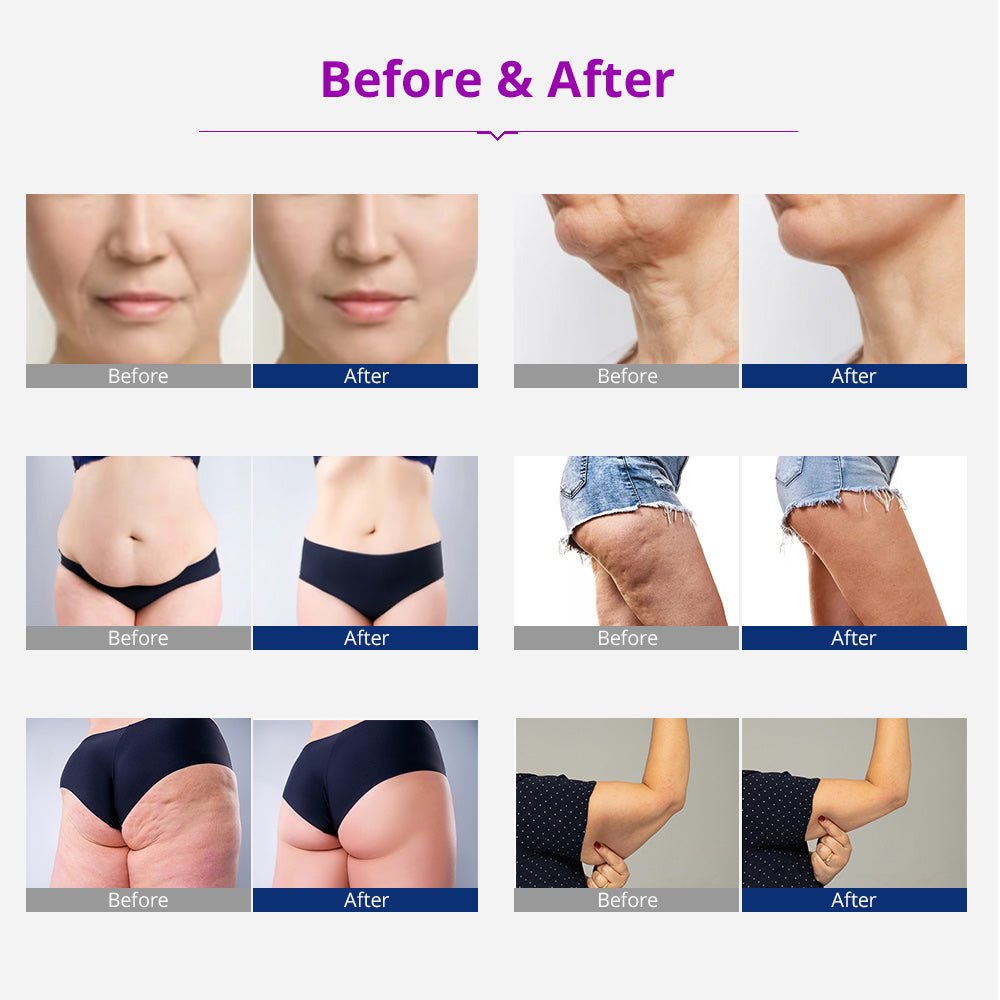 Shape Tactics 5-in-1 Cavitation RF Vacuum Body Contouring System - Renee Lane Company