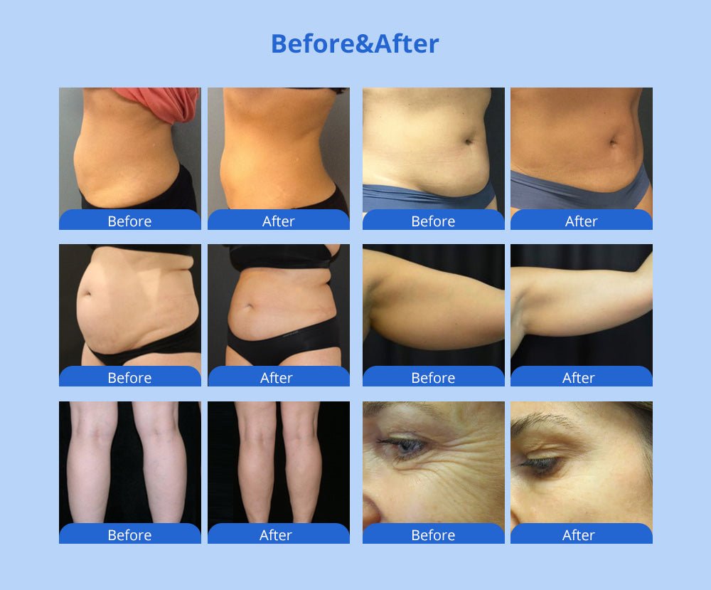 Shape Tactics 5-in-1 Cavitation RF Vacuum LED Laser Body Contouring System - Renee Lane Company