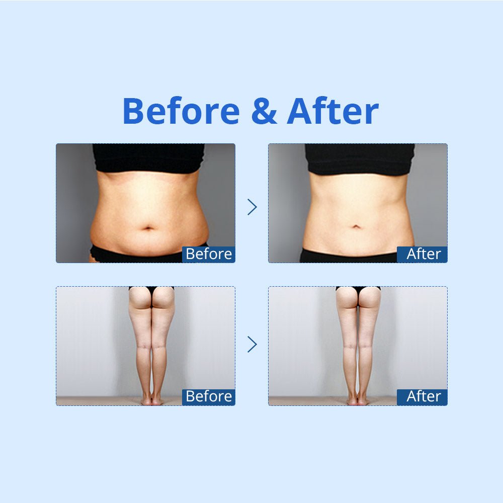 Shape Tactics Cryolipolysis Cold Vacuum Contouring System - Renee Lane Company