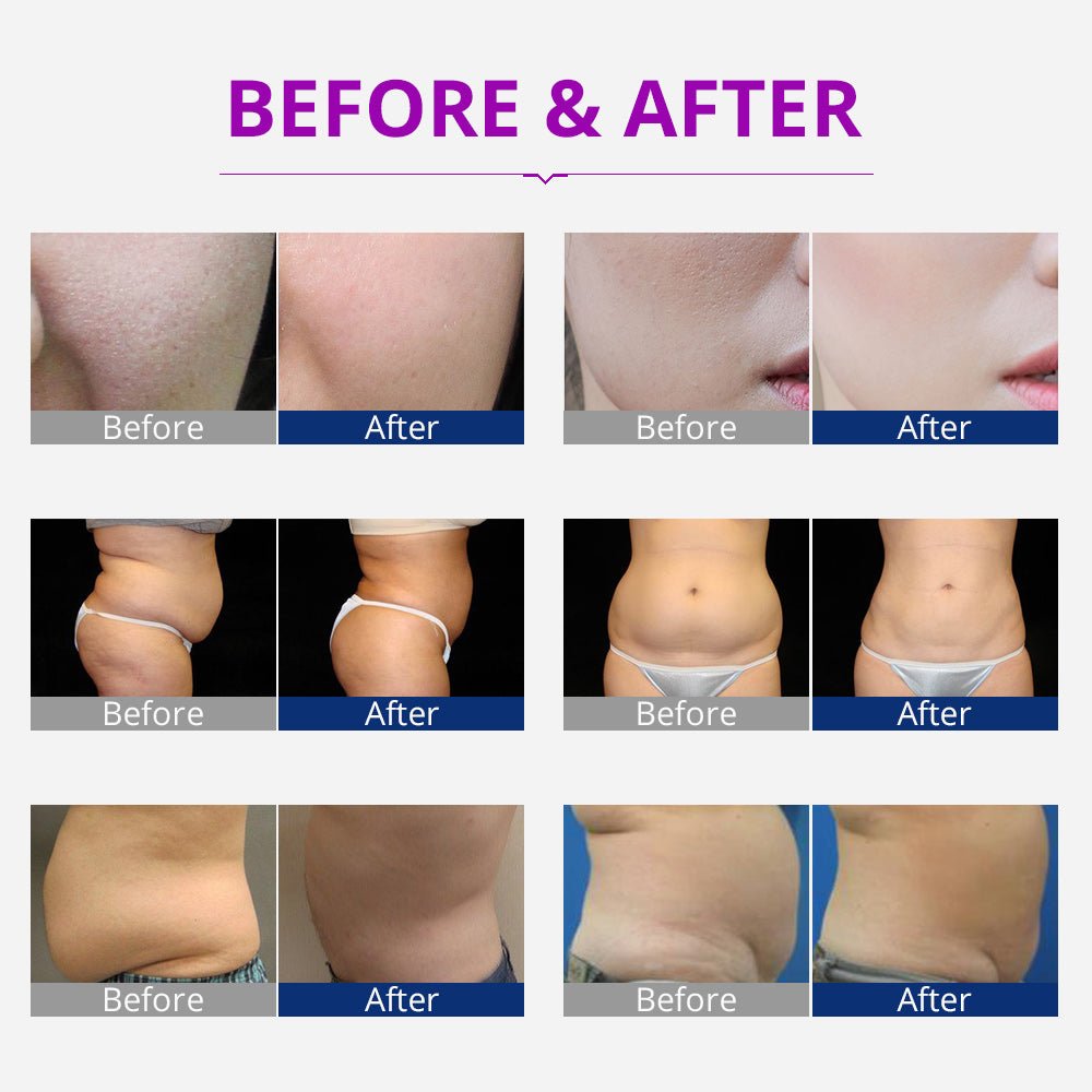 Shape Tactics Portable 5-in-1 Cavitation RF Vacuum Contouring System - Renee Lane Company