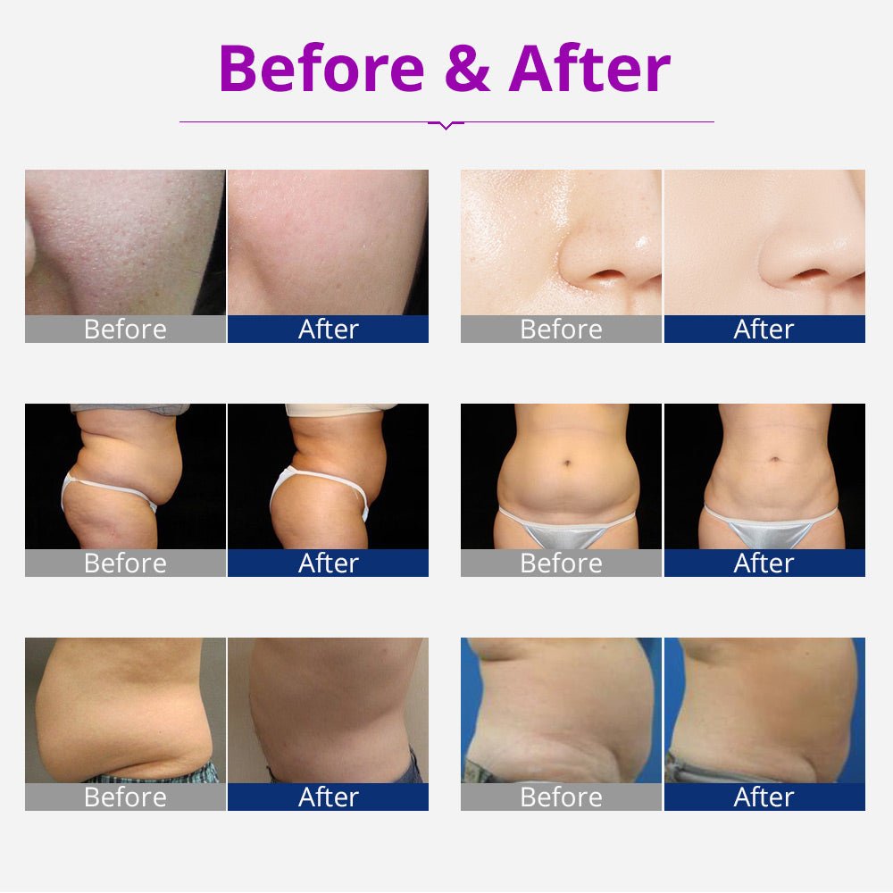 Shape Tactics Portable 6-in-1 Cavitation RF Vacuum Lipo Laser System - Renee Lane Company