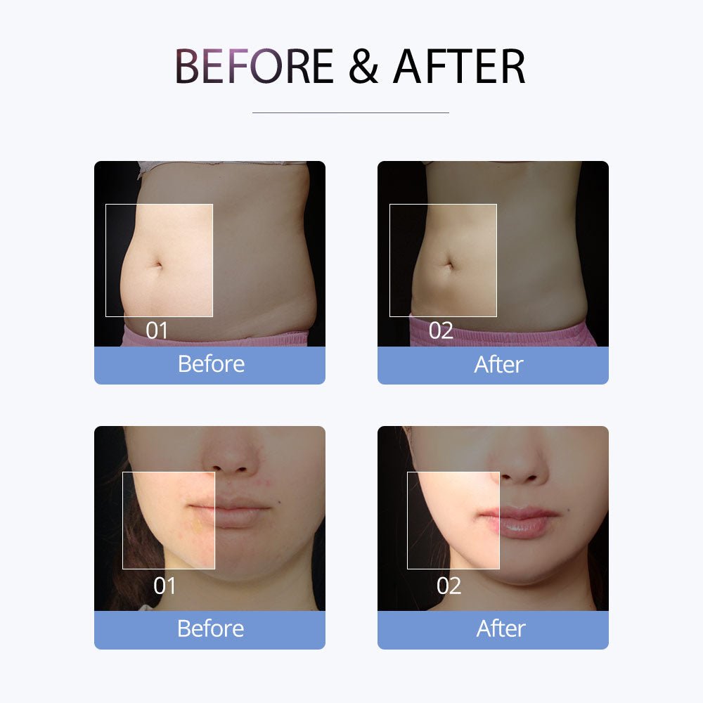 Shape Tactics S-Shape Cavitation RF Electroporation Vacuum System - Renee Lane Company
