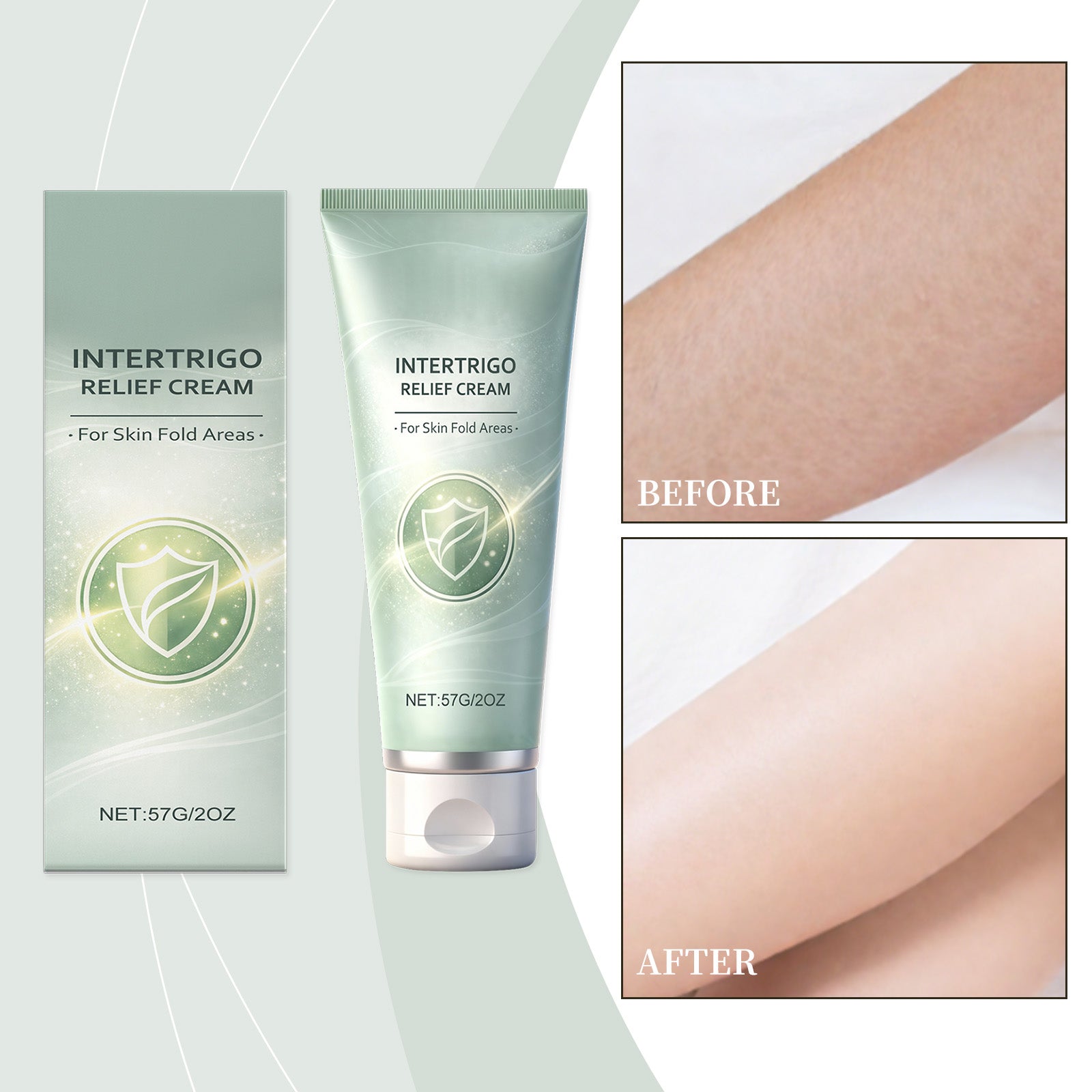 Intertrigo relief cream tube with before-and-after skin results panels