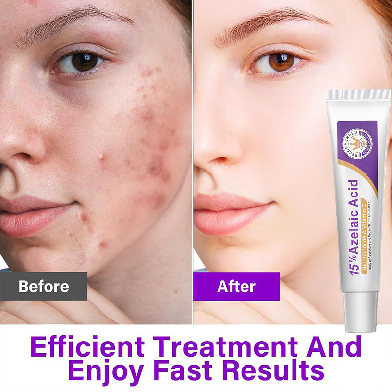 Azelaic acid serum tube shown next to skincare before-and-after faces