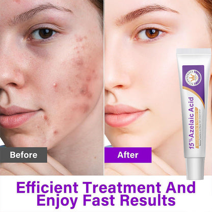 Azelaic acid serum tube shown next to skincare before-and-after faces