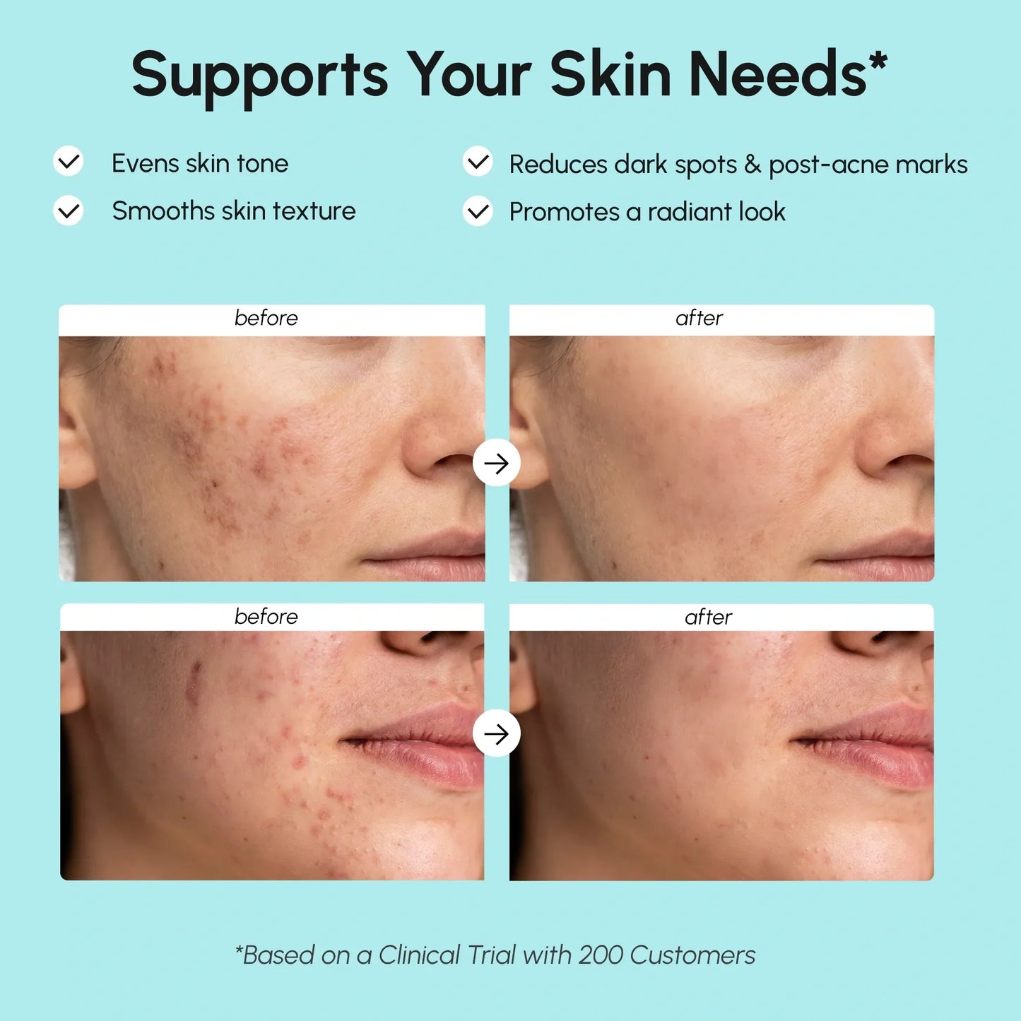 Azelaic Acid Cream for Sensitive Skin - Renee Lane Company