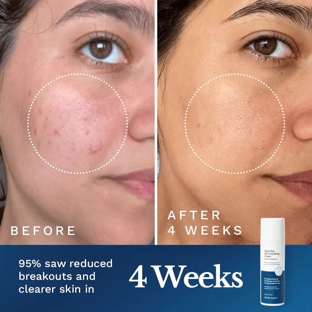 Clear Out Skin Clarifying Cream - Renee Lane Company