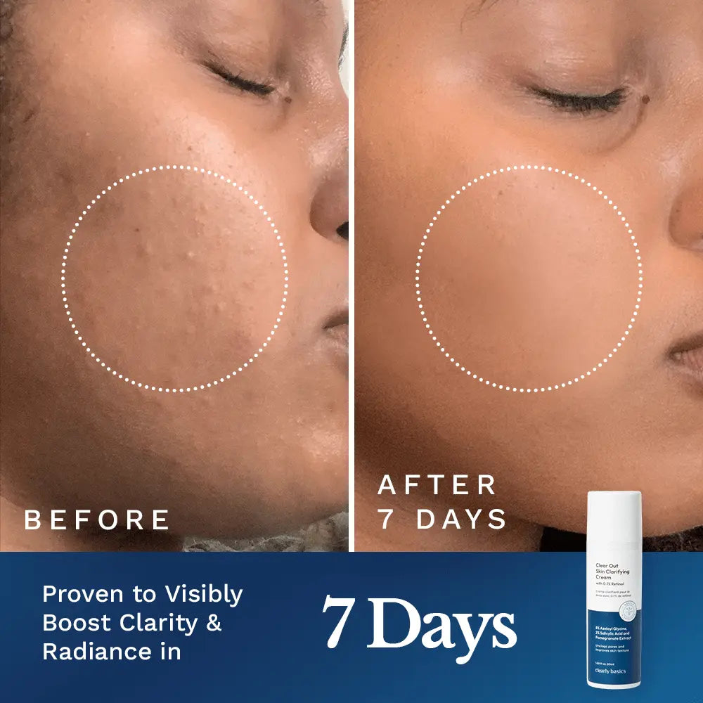 Clear Out Skin Clarifying Cream - Renee Lane Company