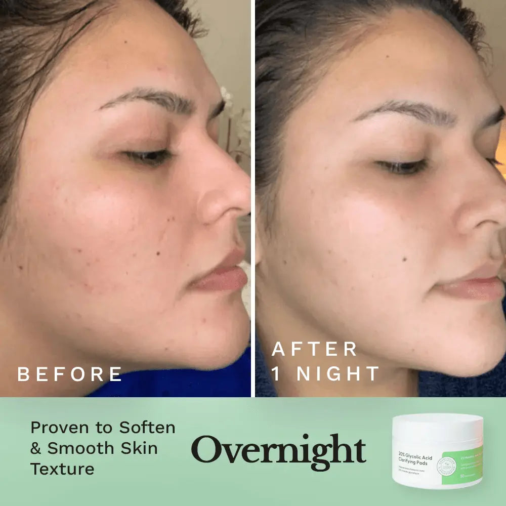 Skincare before-and-after close-up with peel pad jar shown at lower right