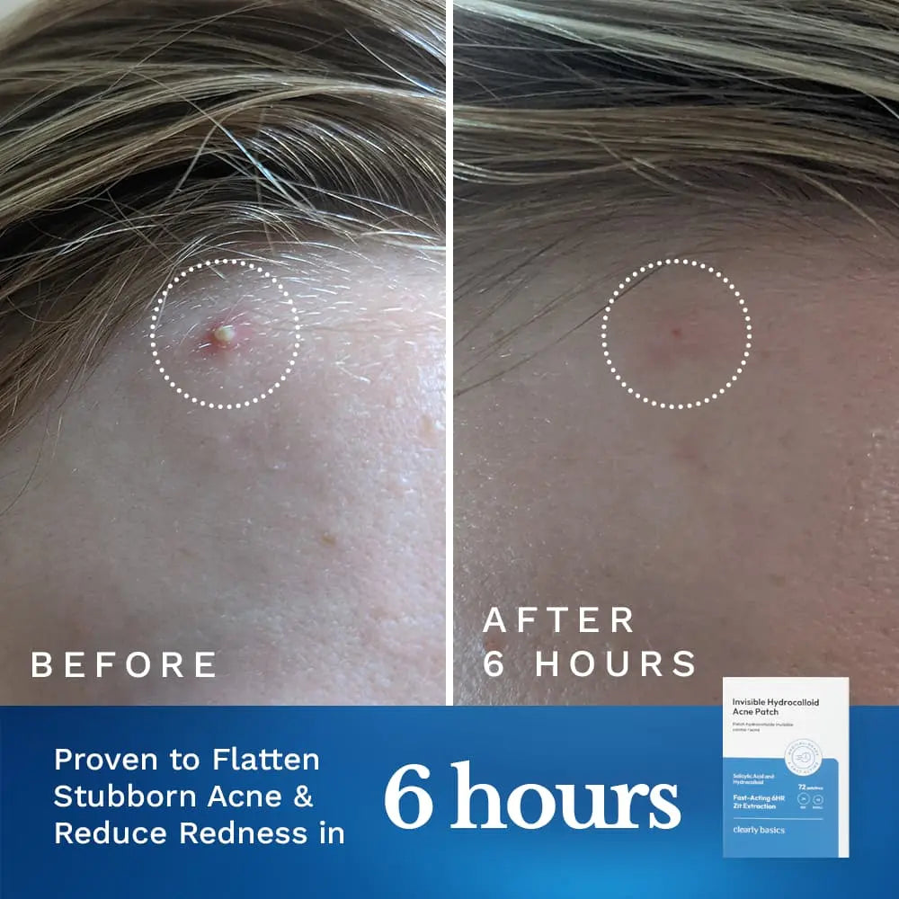 Invisible Acne Patch - Renee Lane Company