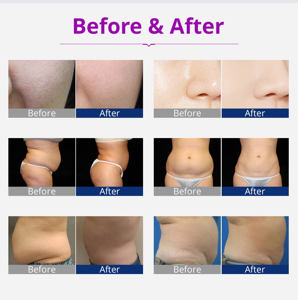 Kim 10 6-in-1 Cavitation RF Lipo Laser System - Renee Lane Company