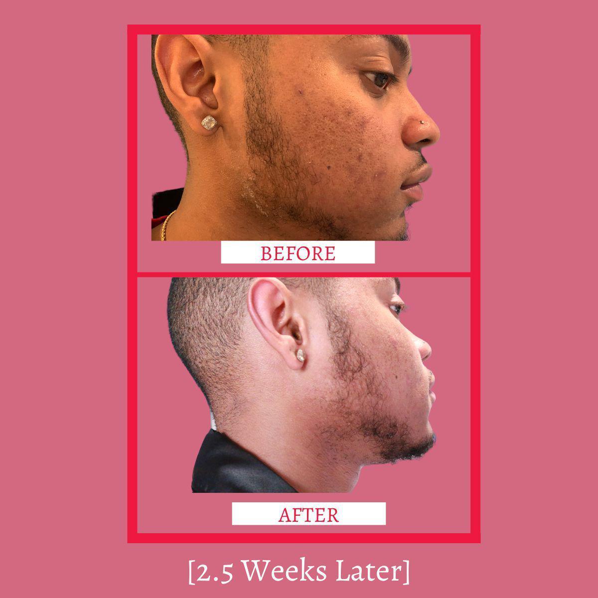 Before-and-after side profile skin comparison on a man with facial hair