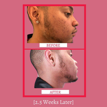 Before-and-after side profile skin comparison on a man with facial hair
