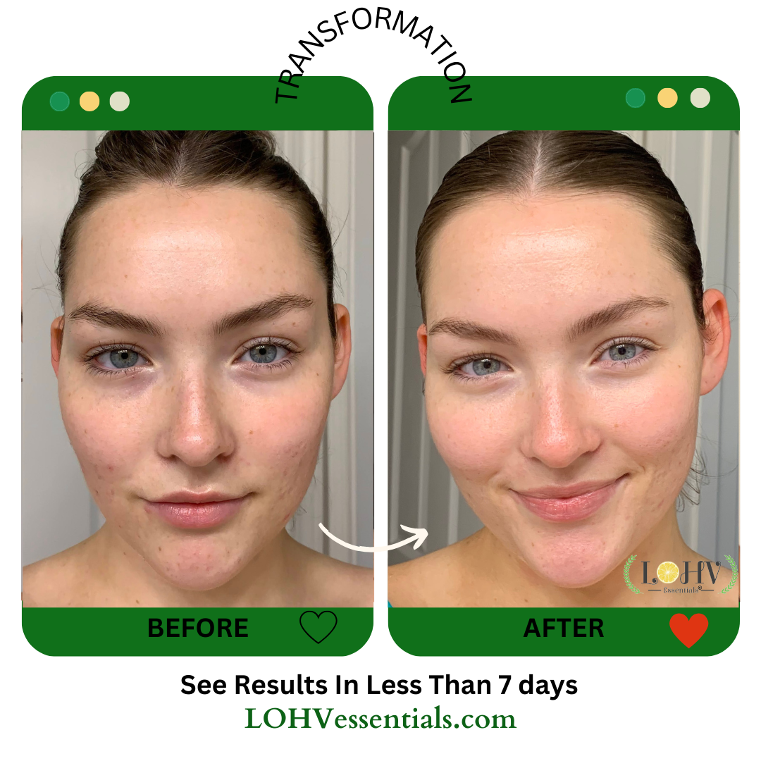 Skincare before-and-after on face with cream visible on cheeks