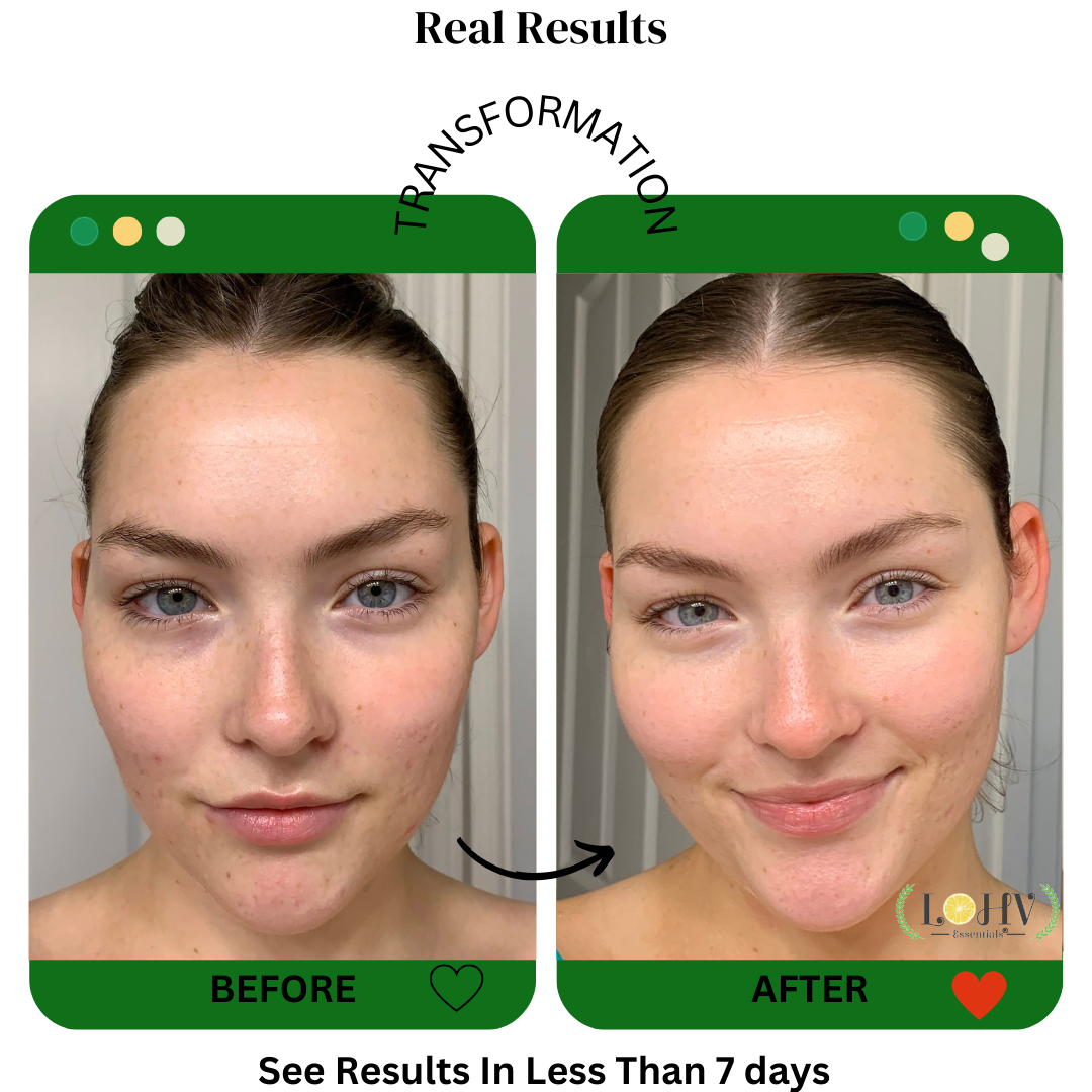 PREMIUM 100% VEGAN Rejuvenating JELLY FACE MASK With Retinol + Turmeric + Aloe Vera + Lactic acid + Rosemary Leaf - Renee Lane Company