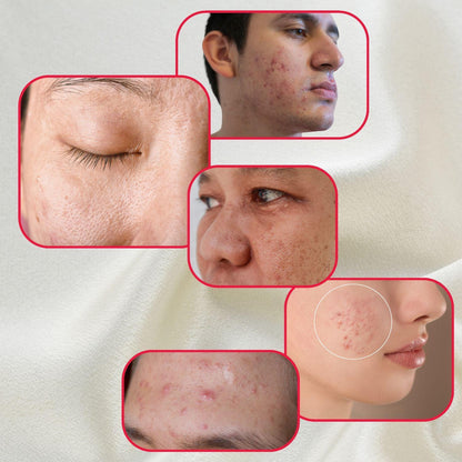Perfect Trifecta Acne Peel - Renee Lane Company