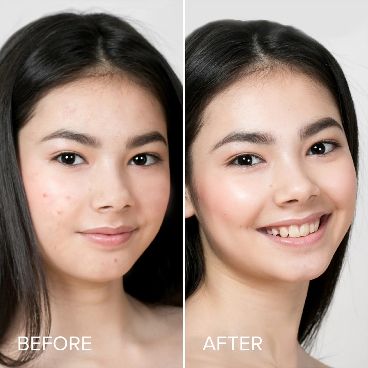 Pimple & Acne Patches - Renee Lane Company