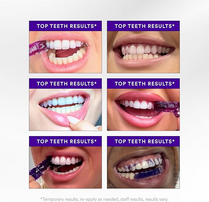Teeth whitening results collage showing multiple smiling mouths