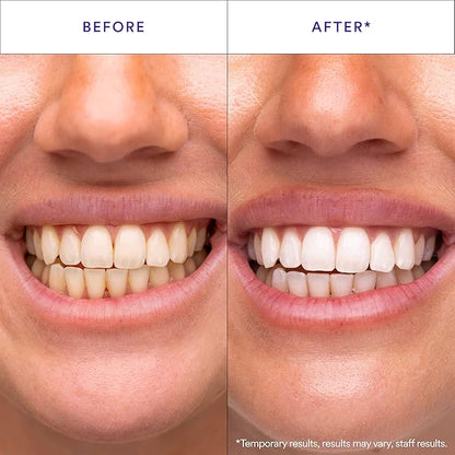 Teeth whitening before-and-after close-up, before left and after right