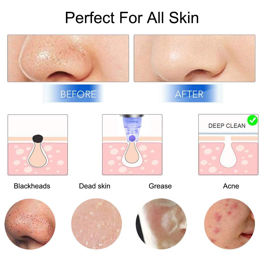 Rejuvenate Your Skin - Blackhead Remover Vacuum - Facial Pore Vacuum Extractor Electric Pore Cleaner - Renee Lane Company