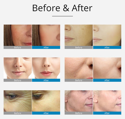 Shape Tactics 2-in-1 RF EMS Mesotherapy Skin Rejuvenation System - Renee Lane Company
