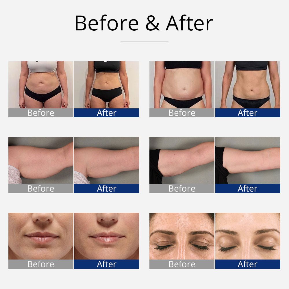 Shape Tactics 4-in-1 Cavitation, RF, and EMS Body Sculpting System - Renee Lane Company