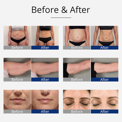 Shape Tactics 4-in-1 Cavitation, RF, and EMS Body Sculpting System - Renee Lane Company