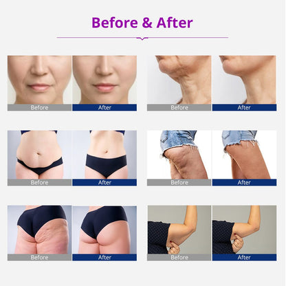 Shape Tactics 5-in-1 Cavitation RF Vacuum Body Contouring System - Renee Lane Company