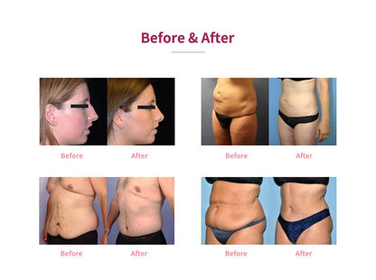 Shape Tactics 5-in-1 Cryolipolysis Vacuum RF Cooling System - Renee Lane Company