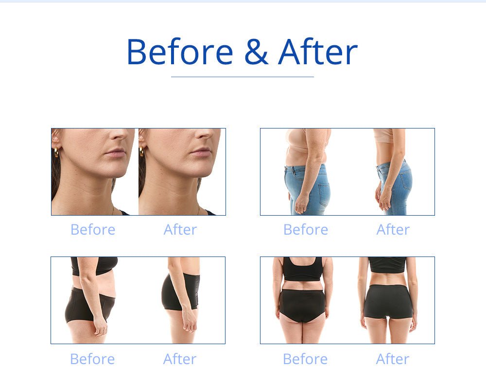 Shape Tactics 5-in-1 RF Cavitation Double-Handle Cryolipolysis Cooling System - Renee Lane Company