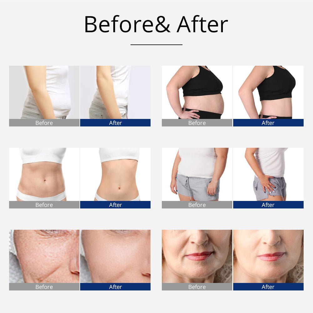 Shape Tactics 5-in-1 Unoisetion Cavitation 2.0 3D Smart Vacuum RF System - Renee Lane Company