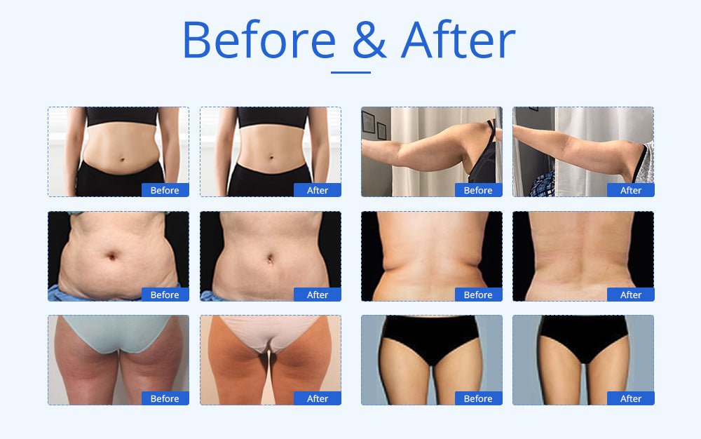 Shape Tactics 6-in-1 Unoisetion Cavitation 2.0 Vacuum RF System - Renee Lane Company