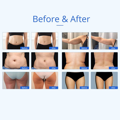 Shape Tactics 6-in-1 Unoisetion Cavitation RF 160mW System - Renee Lane Company