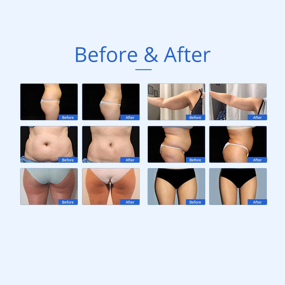 Shape Tactics 7-in-1 40K Ultrasonic Cavitation & RF Hot-Cold Therapy System - Renee Lane Company