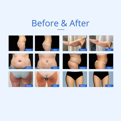 Shape Tactics 7-in-1 40K Ultrasonic Cavitation & RF Hot-Cold Therapy System - Renee Lane Company