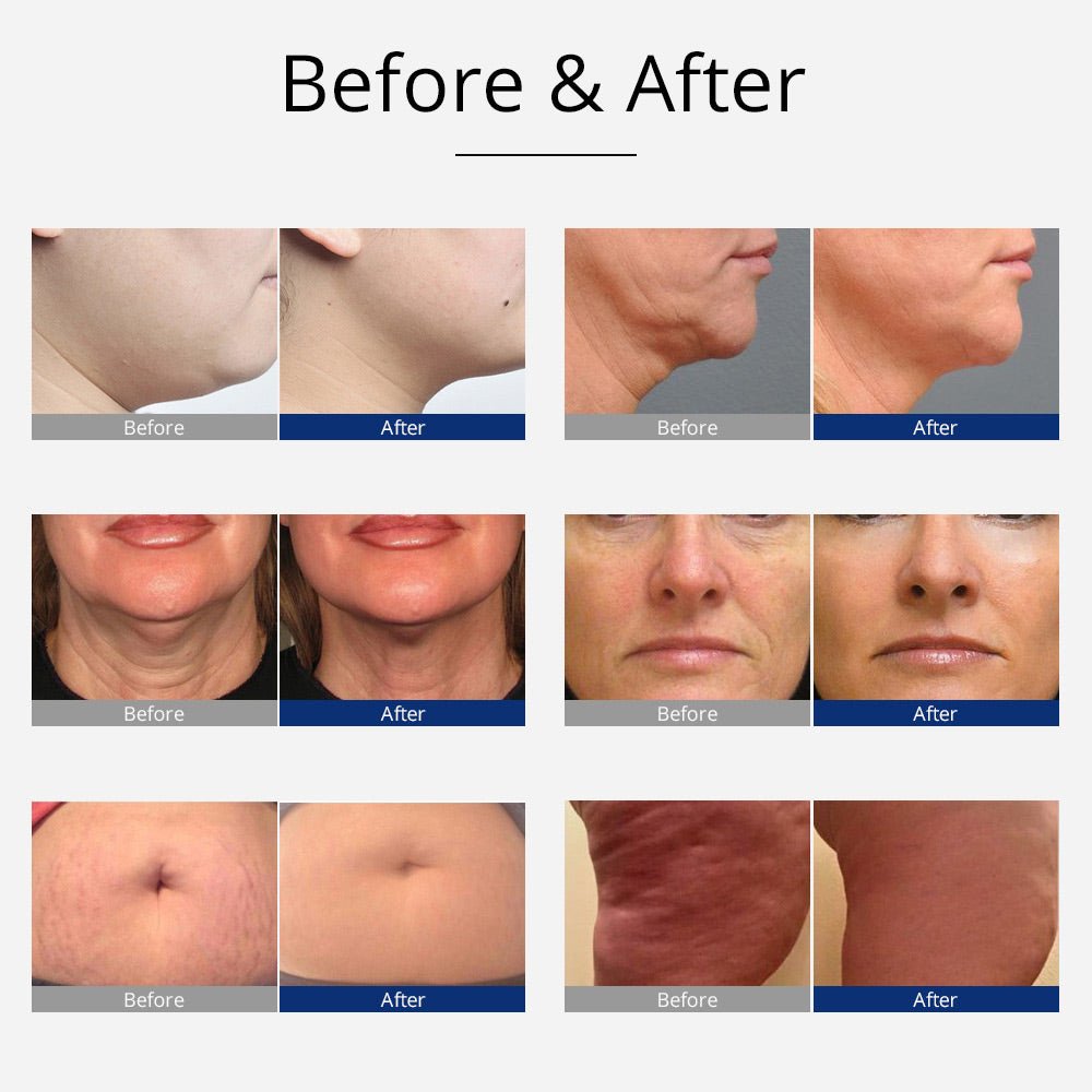 Shape Tactics 8-in-1 Cavitation RF Bio Hot and Cold Therapy System - Renee Lane Company