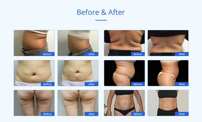 Shape Tactics Advanced 8-in-1 Unoisetion Cavitation & RF System with LED Laser Pads - Renee Lane Company