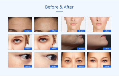 Shape Tactics Advanced 8-in-1 Unoisetion Cavitation & RF System with LED Laser Pads - Renee Lane Company
