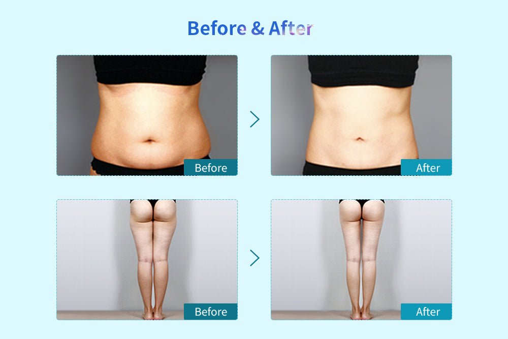 Shape Tactics Cryolipolysis Cold Vacuum Body Contouring System - Renee Lane Company