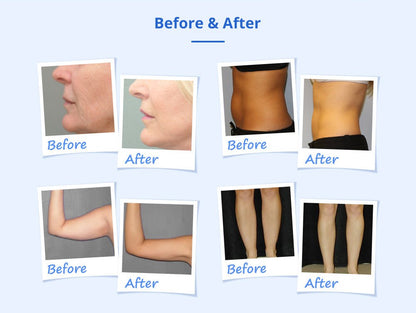 Shape Tactics Cryotherapy 40K Cavitation & RF Contouring System - Renee Lane Company