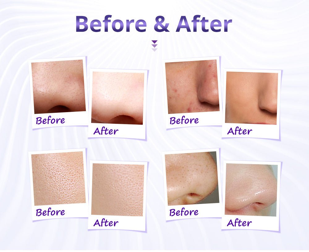 Shape Tactics Diamond Microdermabrasion & Hydrating Mist System - Renee Lane Company