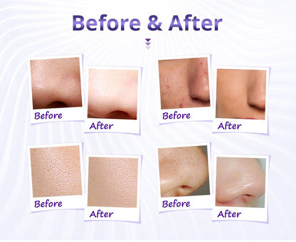 Shape Tactics Diamond Microdermabrasion & Hydrating Mist System - Renee Lane Company