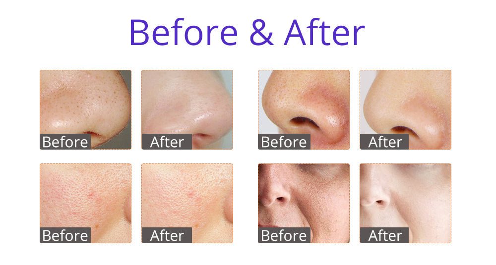 Shape Tactics HydroGlow Pro 6-in-1 Facial Rejuvenation System - Renee Lane Company
