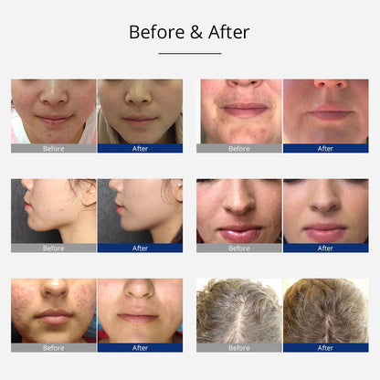 Shape Tactics Portable High-Frequency Facial & Scalp Therapy System - Renee Lane Company