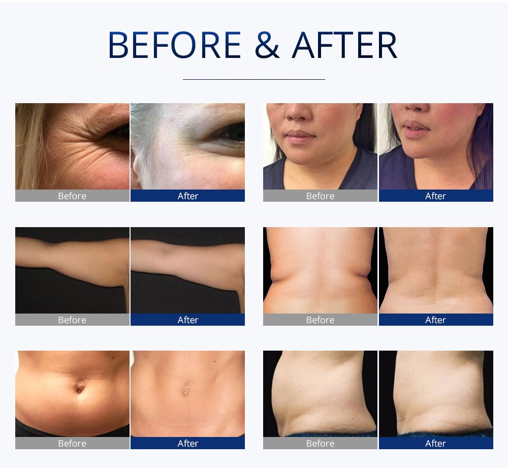 Shape Tactics S-Shape Pro 30K Cavitation RF Contouring System - Renee Lane Company