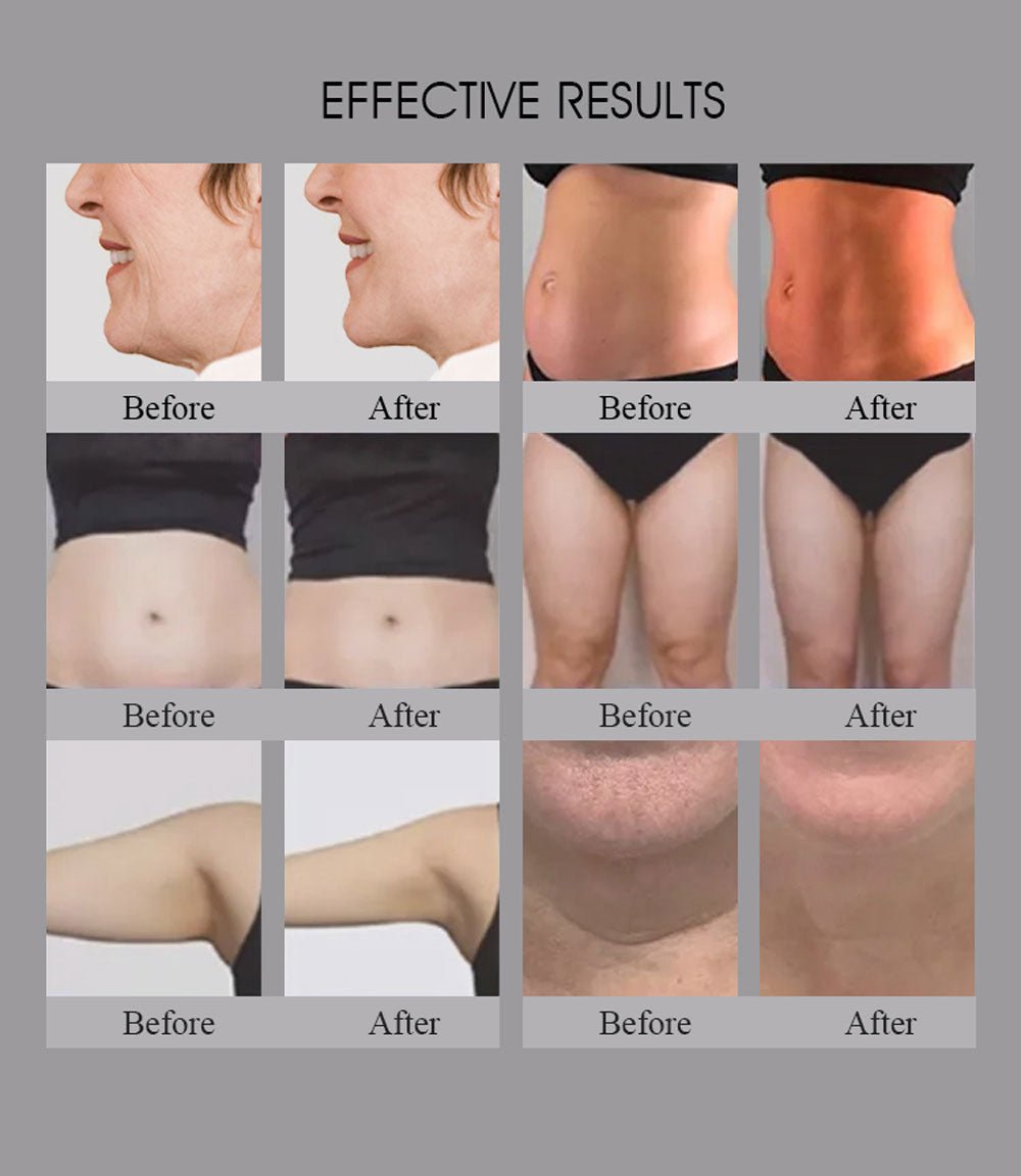Shape Tactics Smart RF Body Contouring and Skin Rejuvenation System - Renee Lane Company