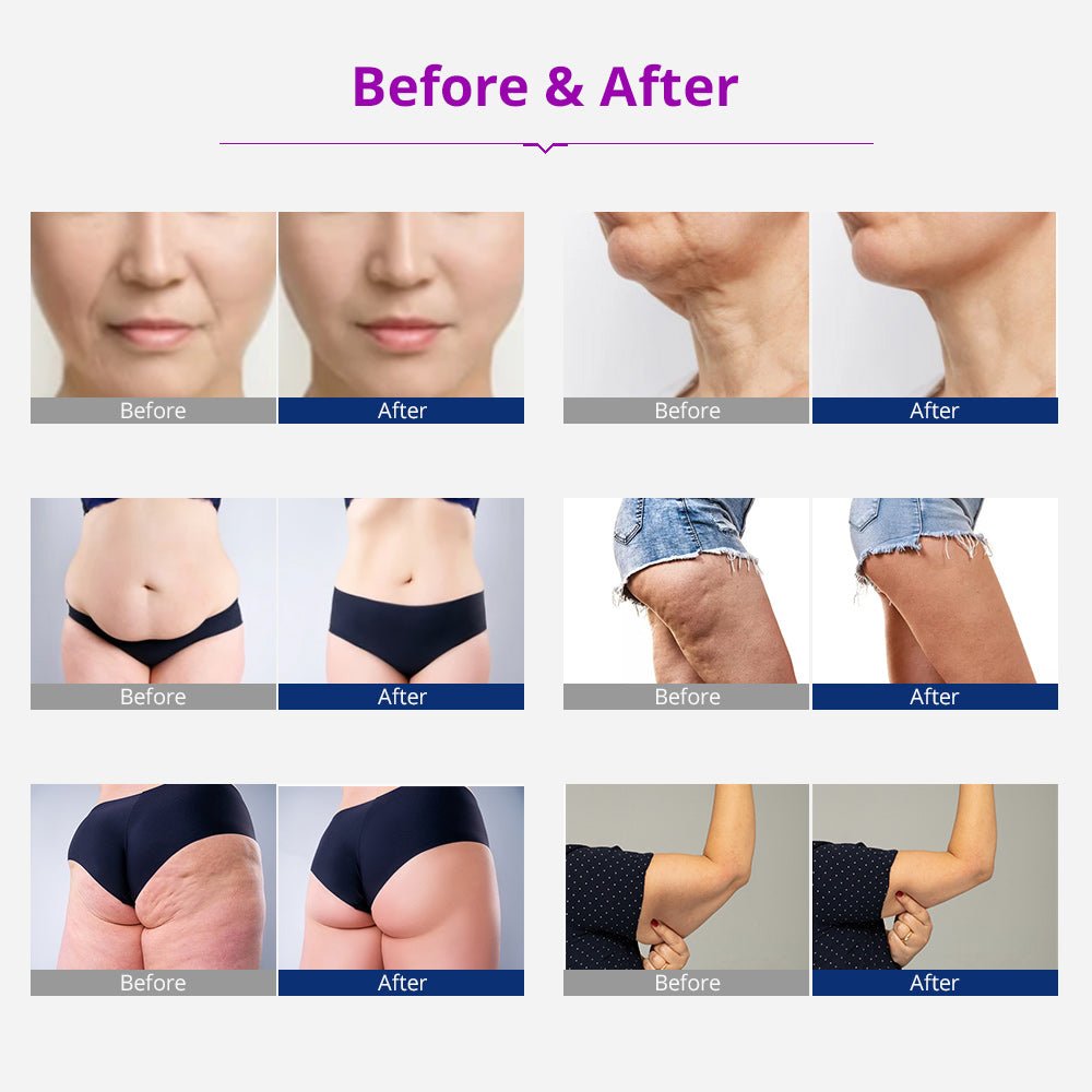 Shape Tactics Unoisetion 40K Cavitation Ultrasound RF Vacuum Photon System - Renee Lane Company