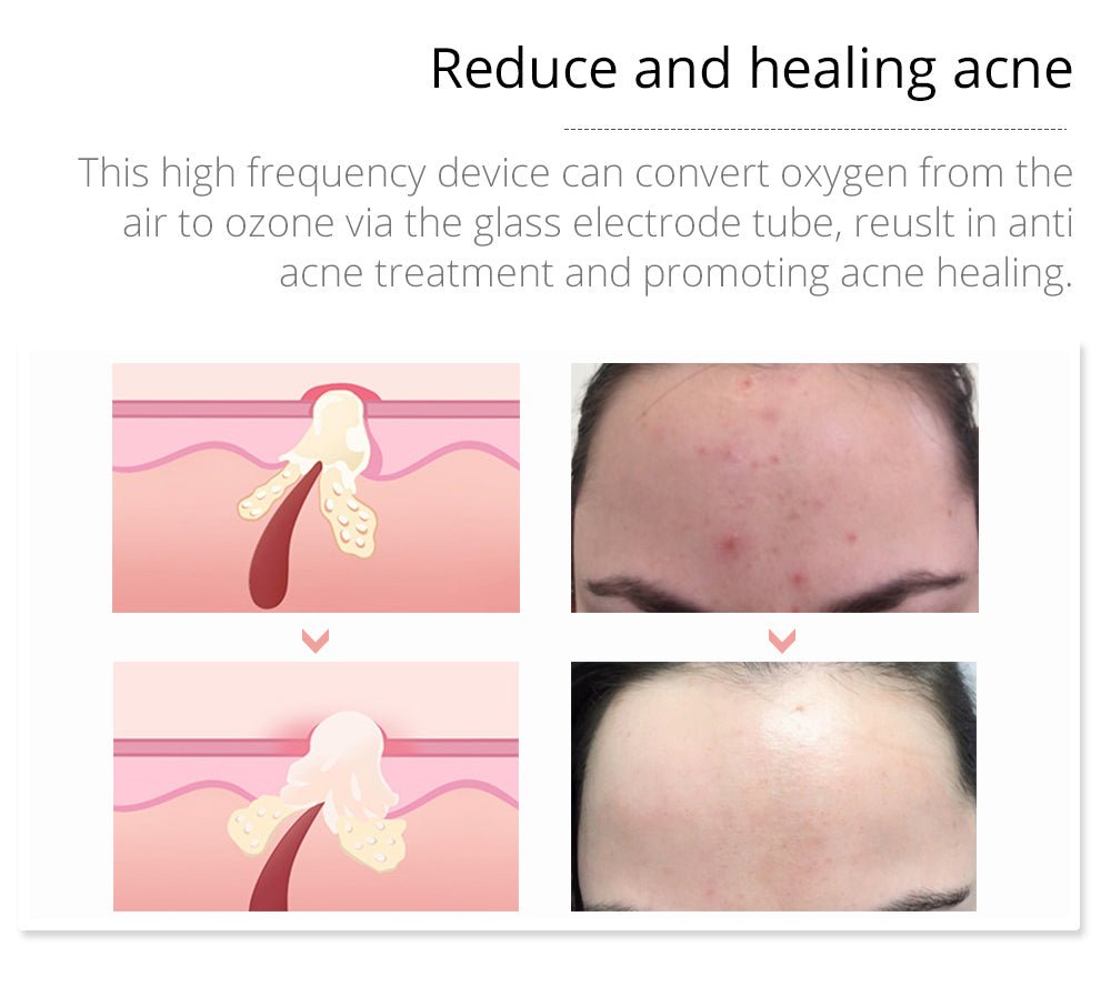 Shape Tactics Violet 7-Electrode High-Frequency Facial System - Renee Lane Company